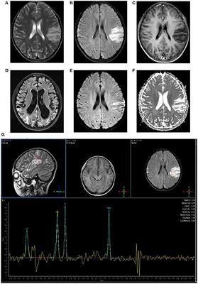 MRI Features of Stroke-Like Episodes in Mitochondrial Encephalomyopathy With Lactic Acidosis and Stroke-Like Episodes